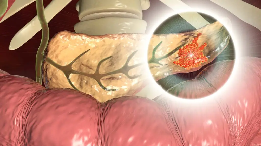 Visual related to what are the causes of pancreatic cancer?